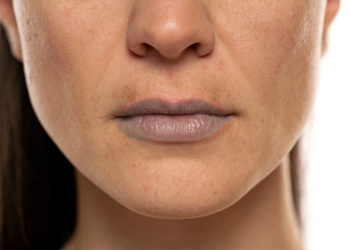 Dark Lips Treatment in Delhi